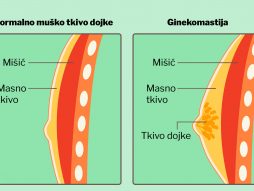 ginekomastija