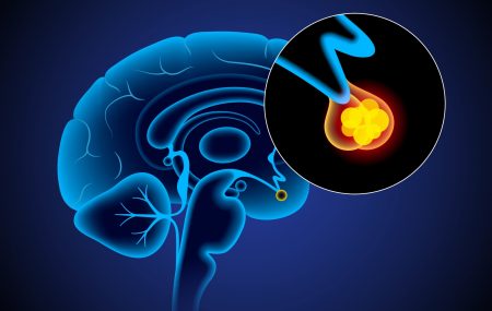 tumor hipofize