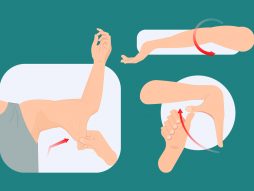 Ehler-Danlos sindrom