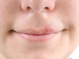 herpes na usni