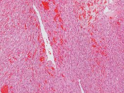 Angiosarkom