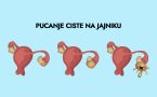 Pucanje ciste na jajniku